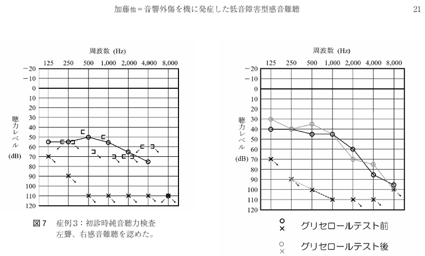 右耳が6分法で６０．８ｄB　左耳が聾ですね。７級３号の後遺障害に該当でしょうか？
