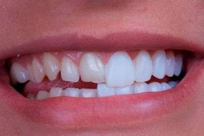 faceta-de-porcelana-1-300x200.jpg
