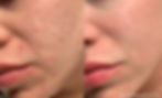 morpheus8-before-after-dr-g-ellis-preview-1