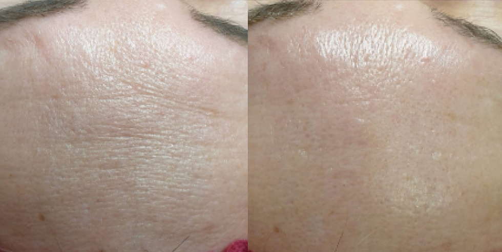 biorepeel before and after wrinkles