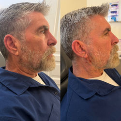 Mens Neck ThreadLift Before and After