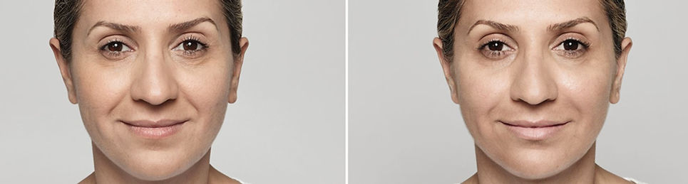 Restylane filler for lines before and after photo