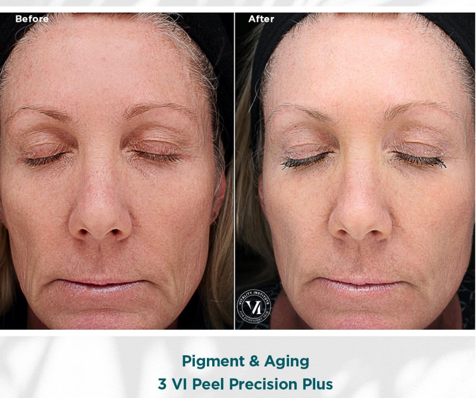 VI Peel Precision Plus Pigment and Aging Results