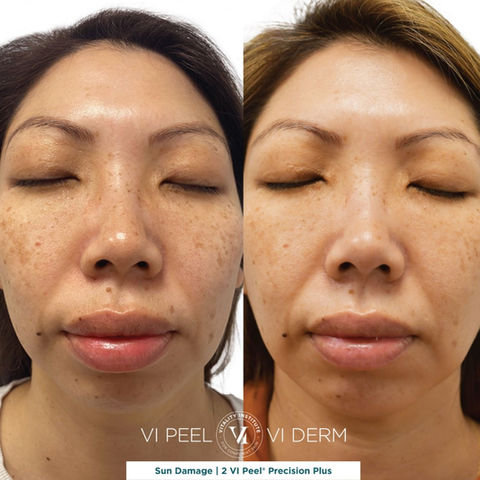 VI Peel Results