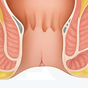 Anal Fissure.png
