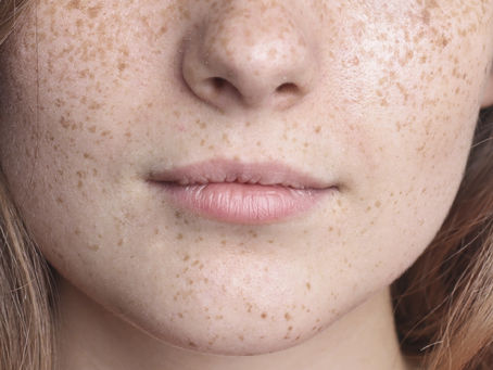 Best Sun Damage Treatment in Lee's Summit, MO