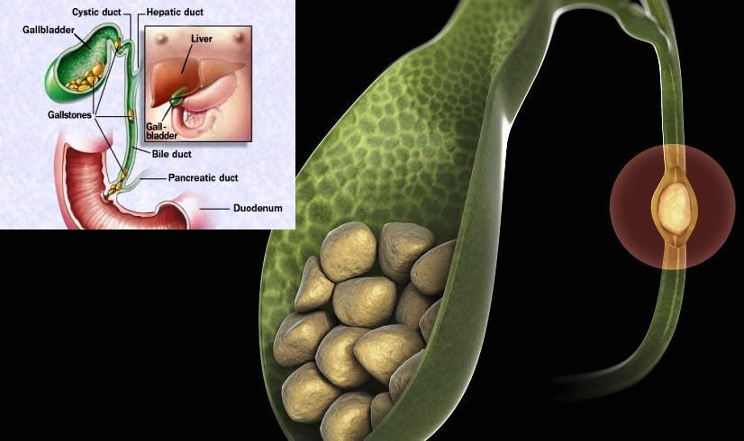 GALLSTONES WHAT ARE THEY 