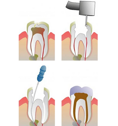 Kanal Tedavisi Endodonti