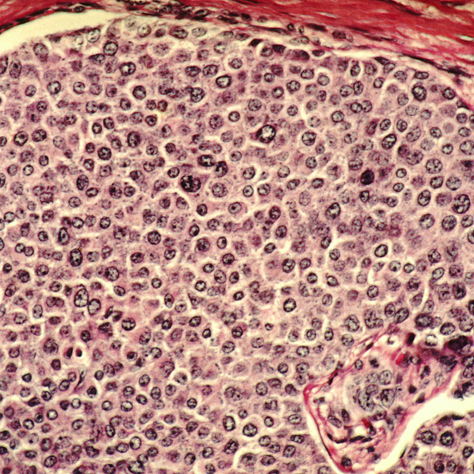 Why Is Cancer Hard To Cure?