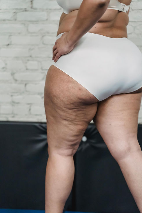 Cellulite