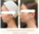 Jaw line contouring with Morpheus8_edited