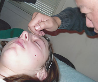 A person receiving acupuncture treatment on their forehead