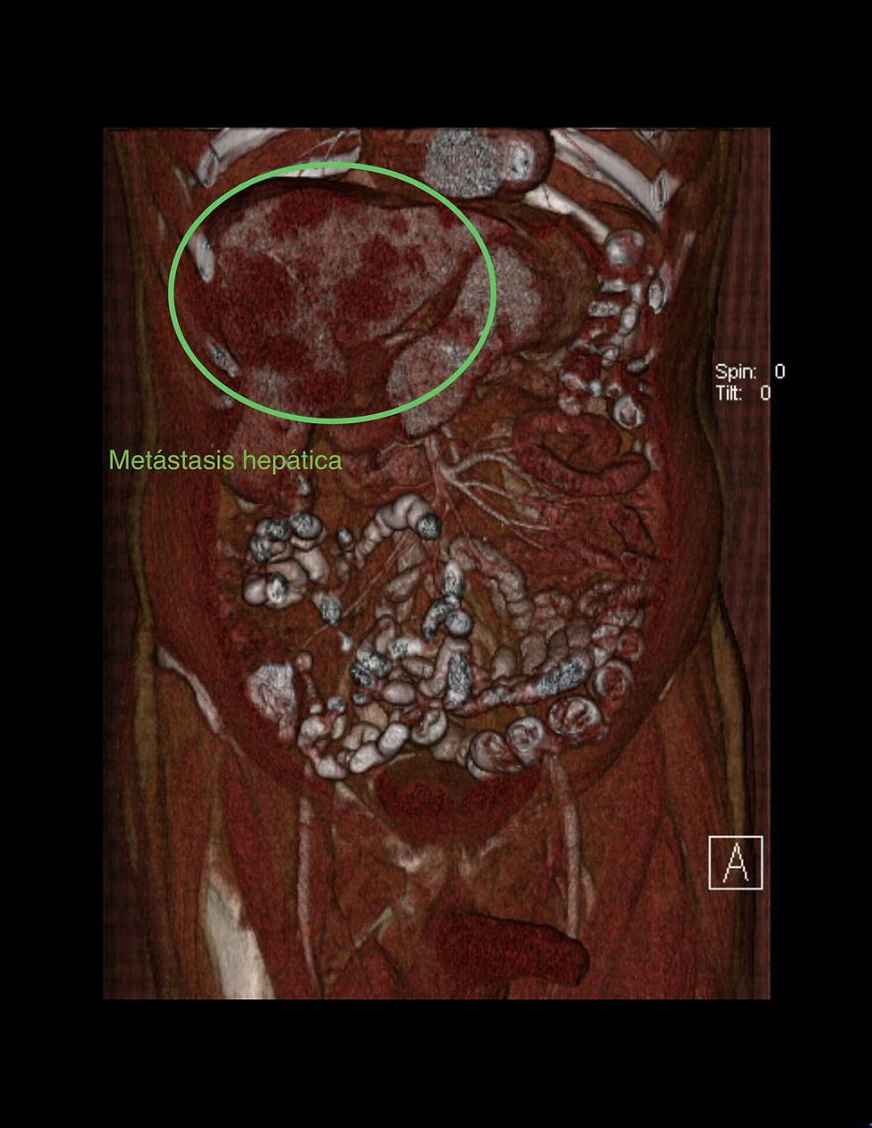 Posible Neoplasia Gástrica Metastásica