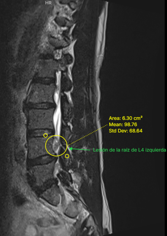 Tumor de vaina nerviosa (schwannoma versus neurofribroma) (Pet Virtual)