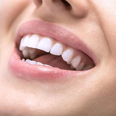 Best Teeth Whitening in Dubai