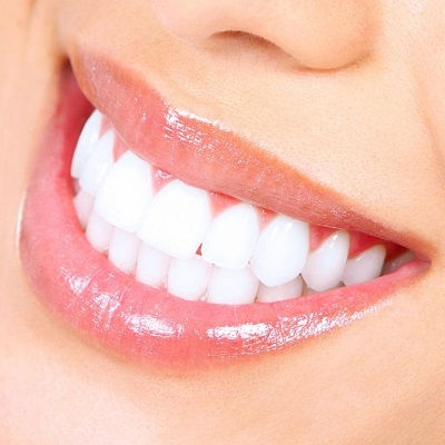 Teeth Whitening Cost in Dubai