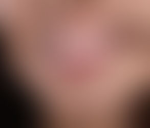 Is a Gingivectomy Permanent or Reversible?