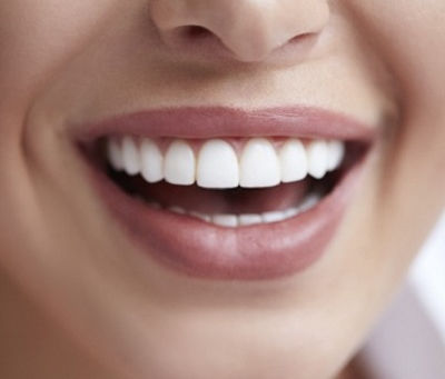 How Dental Veneers Fix Cracked Front Teeth