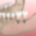 How Long Do Dental Implants Last?