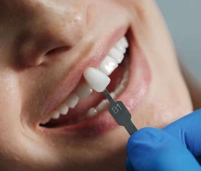 Myths About Composite Veneers Debunked