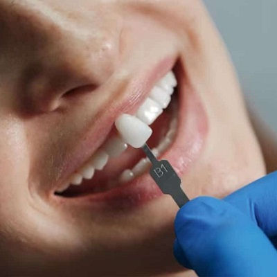 Composite Veneers Dubai