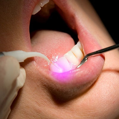 Gum Depigmentation In Dubai