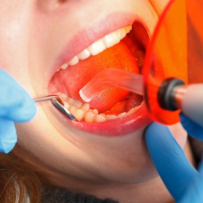 Dental Tooth Filling in Dubai