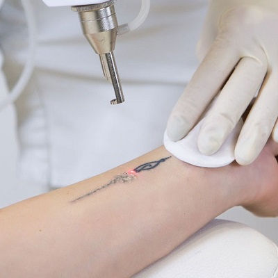 Laser Tattoo Removal in Muscat