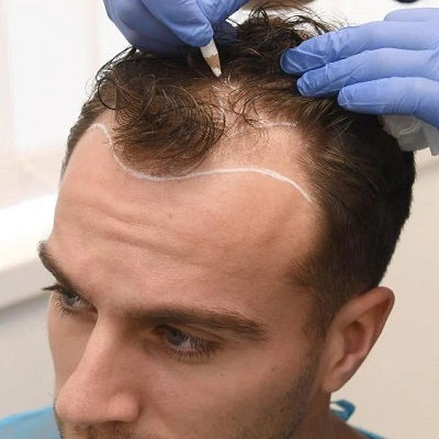 زراعة الشعر سعر في مسقط
