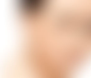 إعادة تشكيل الأذن: هل يمكنها حل مشاكل شكل الأذن؟