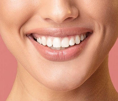 Can You Whiten Dental Veneers?