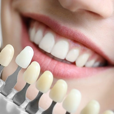 Best Composite Veneers Dubai