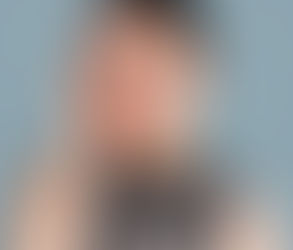 أفضل خيارات علاج ندبات حب الشباب لبشرة ناعمة