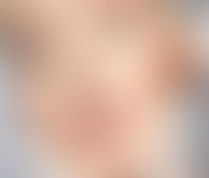 The Role of Cheek Fillers in Restoring Volume to the Midface