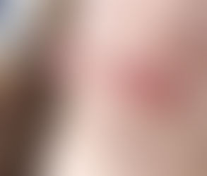 How Lip Filler Injections Can Add Volume and Shape to Your Lips