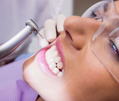 Teeth Polishing and Scaling for Smile Makeovers
