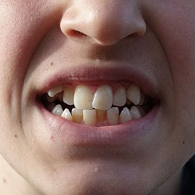 Crowded Teeth Treatment Dubai