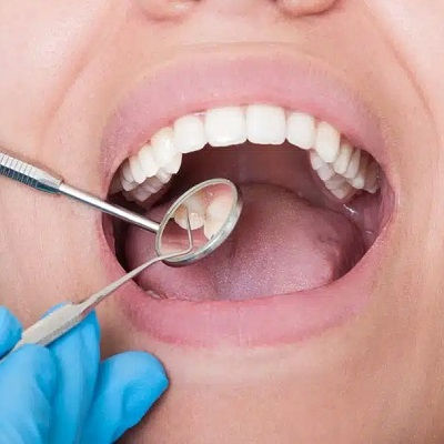 Best Teeth Cleaning in Dubai