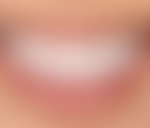 Digital Smile Design and Its Role in Gum Contouring in Dubai