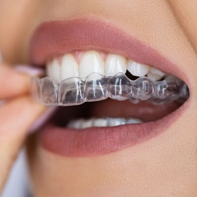 Aligners in Dubai