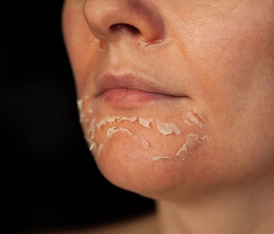 How TCA Peel Compares to Laser for Skin Rejuvenation