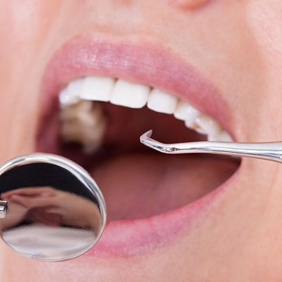 SMART – Dental Amalgam Removal Dubai