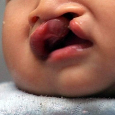 Palate Repair Surgery Clinic in Muscat