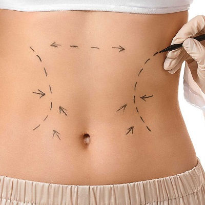 أفضل شفط الدهون في مسقط