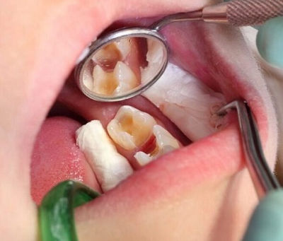 Dental Tooth Filling Options for Teens & Adults