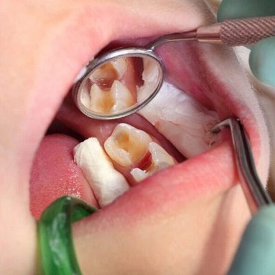 Best Dental Tooth Filling Dubai