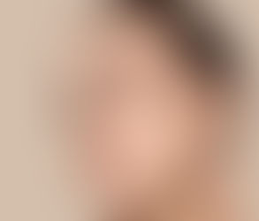 ماذا يحدث أثناء إجراء حقن الفيلر الجلدي؟
