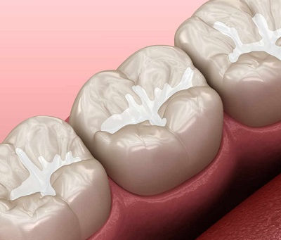 Everything You Need to Know About Tooth Fillings in Dubai