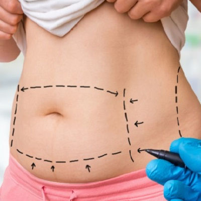 Vaser 4D Liposuction Clinic in Oman