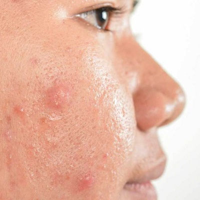 Acne Scar Treatment Clinic in Muscat
